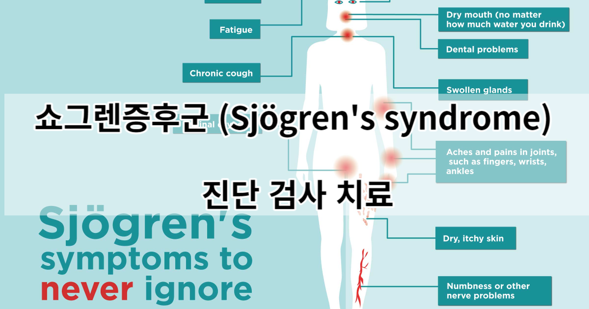 쇼그렌증후군(Sjögren's syndrome) 진단 검사 치료
